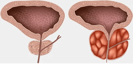 What is prostate