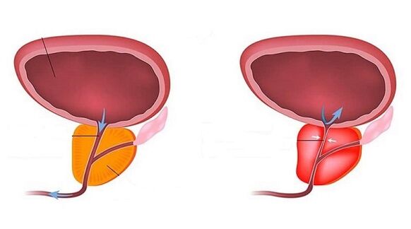 healthy and inflamed prostate with prostate