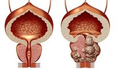 Healthy and unhealthy prostate
