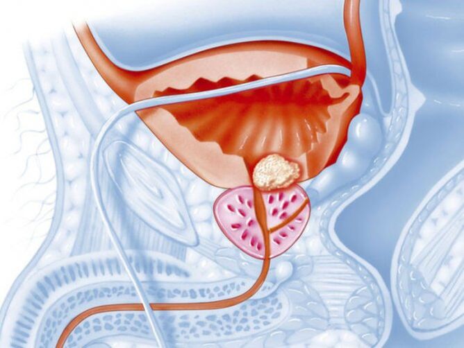 congestive prostatitis discharge