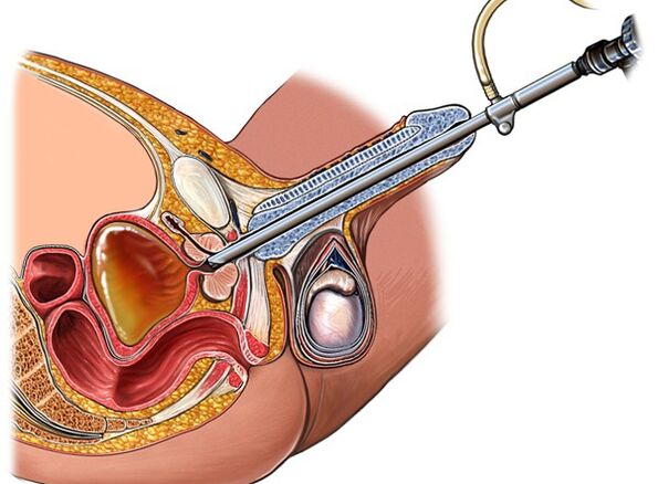 Treatment of prostatitis