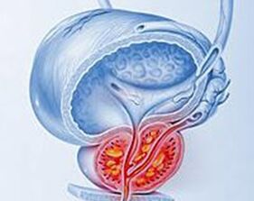 inflammation of the prostate with prostate